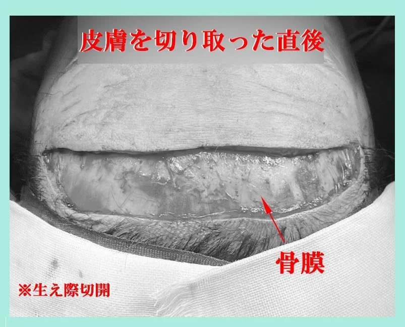 驚くほど傷跡の美しい、切開式前額リフト（ひたい挙上）術の、超詳しいブログ～！