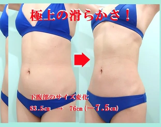 劇的クビレ作成術！ ベテラン美容外科医独自の職人技で、超滑らかな仕上がりになる！