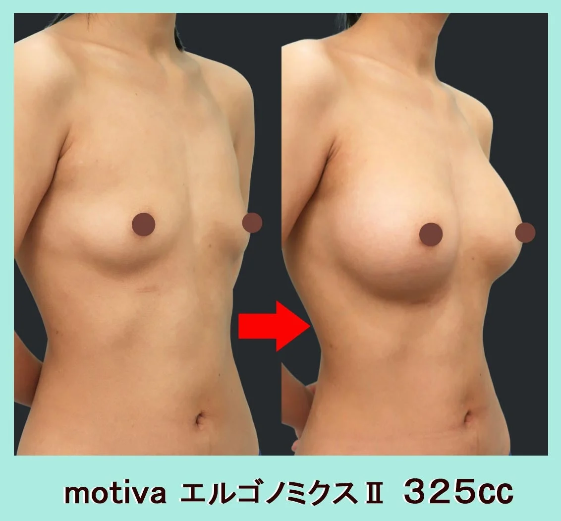 シリコン豊胸の基礎の基礎。デュアルプレーン法で、たおやかで美しいバストを作り上げてみた！