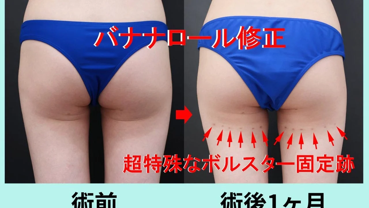 バナナロール修正、ヒップ下を吸引され過ぎて下臀溝が落ちちゃった人には、脂肪注入とボルスター固定！